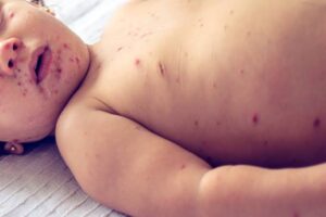 Signs of measles